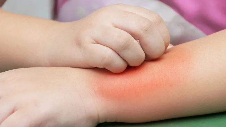 Alergi Buah Kesemek pada Anak anak